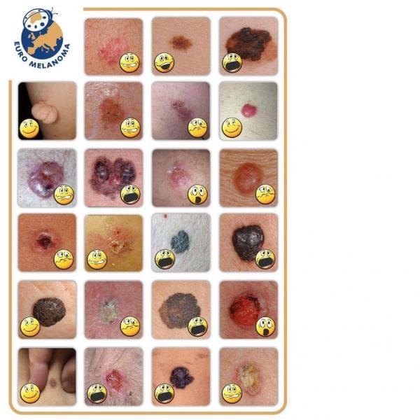 melanoma odos vezys apgamas apgamai apgamu pokyciai apgamu tyrimai apgamas kraujuoja dideja apgamu tyrimai odos klinika dermatologe grozio pasaulis kaunas